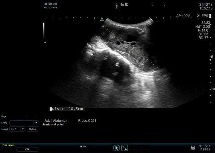 Comprehensive Treatment of Anaplastic Thyroid Cancer: A Case Report.