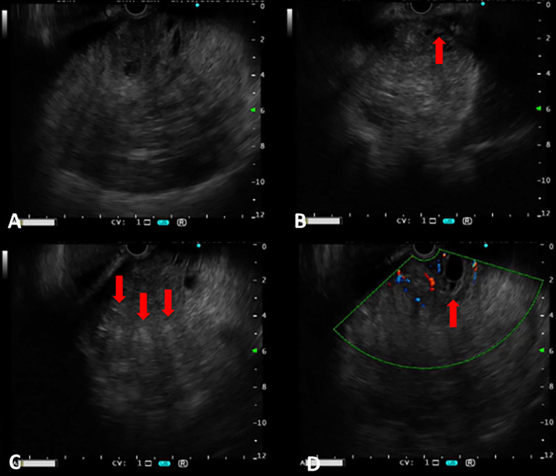 Succinate dehydrogenase-deficient gastrointestinal stromal tumor of the stomach: EUS and contrast-enhanced EUS features (with videos).