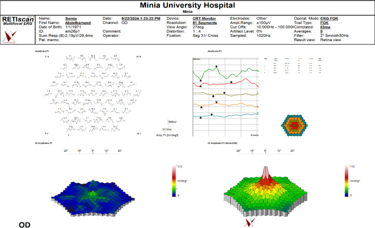 Use of a multifocal electroretinogram to evaluate the therapeutic effect of a single intravitreal dexamethasone implant, Ozurdex<sup>®</sup>, for refractory diabetic macular oedema.