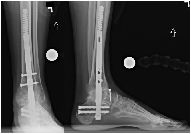 Complications and Early-Term Radiographic Analysis of a Novel Active Compression Tibiotalocalcaneal Arthrodesis Nail With a Proximal Flexible Coil.