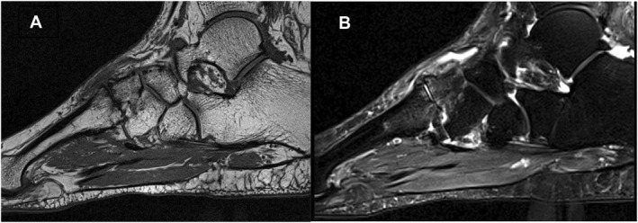 Association between clinical and MRI-detected imaging findings for people with midfoot pain, a cross-sectional study.