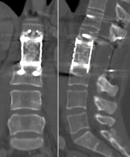 Long-term Titanium mesh cage implant failure after total en bloc spondylectomy due to spinal chondrosarcoma