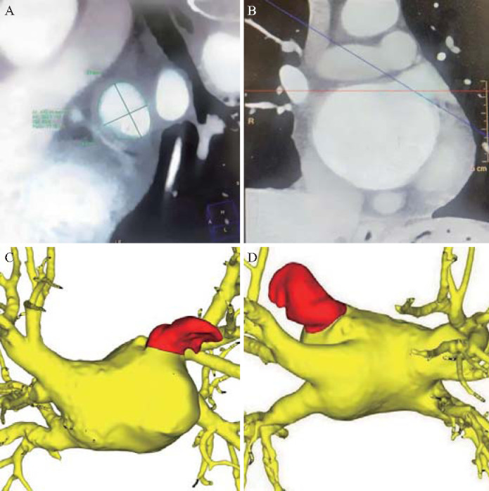 [Efficacy and safety of concomitant left atrial appendage clipping during heart valve surgery: a report of 58 cases].