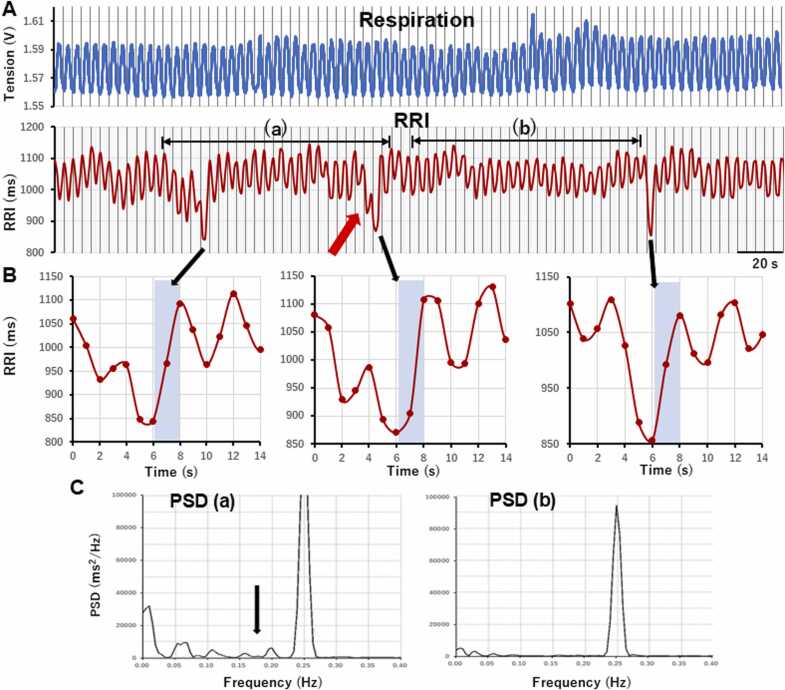 The difference in arterial baroreflex sensitivity between the supine and standing positions in healthy subjects.