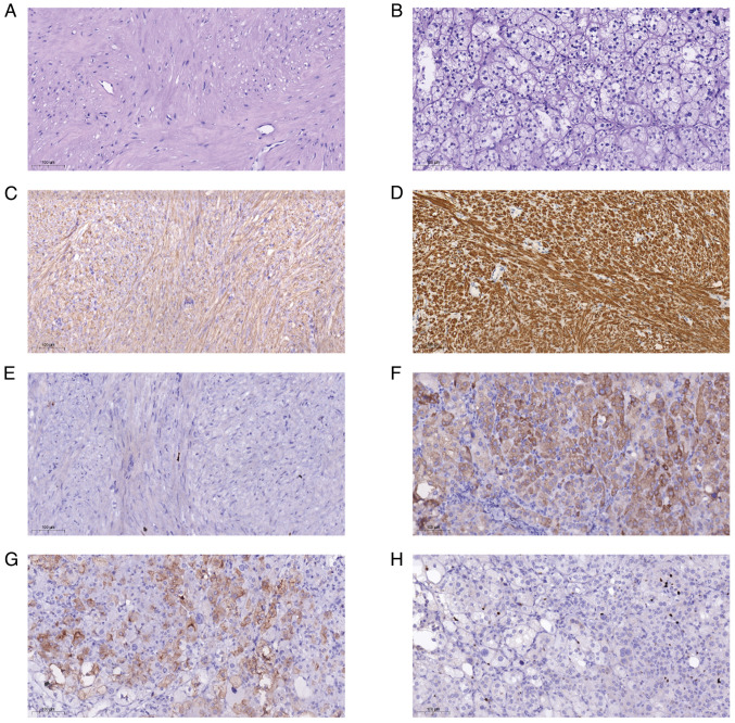 Misdiagnosis of esophageal leiomyoma combined with adrenal cortical adenoma as esophageal cancer with adrenal metastasis by fluorine-18-fluorodeoxyglucose positron emission tomography: A case report.
