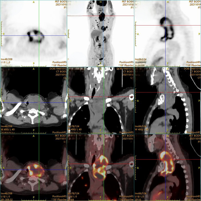 Comprehensive Treatment of Anaplastic Thyroid Cancer: A Case Report.