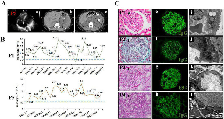 Ras-MAPK pathway in patients with lupus nephritis.