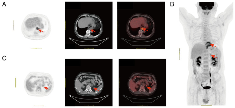 Misdiagnosis of esophageal leiomyoma combined with adrenal cortical adenoma as esophageal cancer with adrenal metastasis by fluorine-18-fluorodeoxyglucose positron emission tomography: A case report.