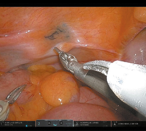 Robot‑assisted resection of a rare bladder tumor facilitated by perioperative bladder wall tattooing.