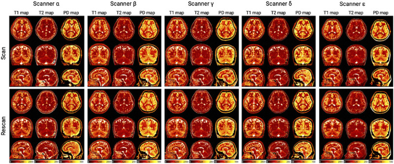 Decoding Brain Development and Aging: Pioneering Insights From MRI Techniques.