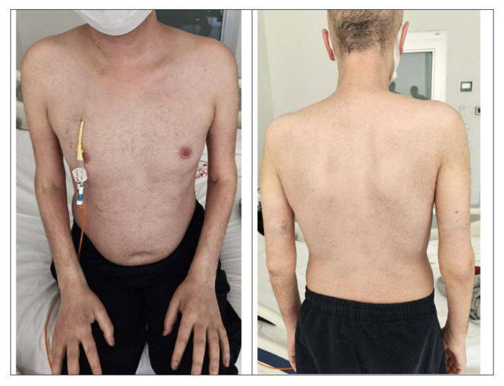 Successful Management of Steroid-Resistant cutaneous Acute Graft-versus-Host Disease, Toxic Epidermal Necrolysis-Like, with Ruxolitinib.