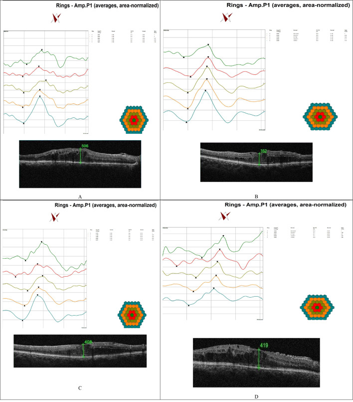 Use of a multifocal electroretinogram to evaluate the therapeutic effect of a single intravitreal dexamethasone implant, Ozurdex<sup>®</sup>, for refractory diabetic macular oedema.