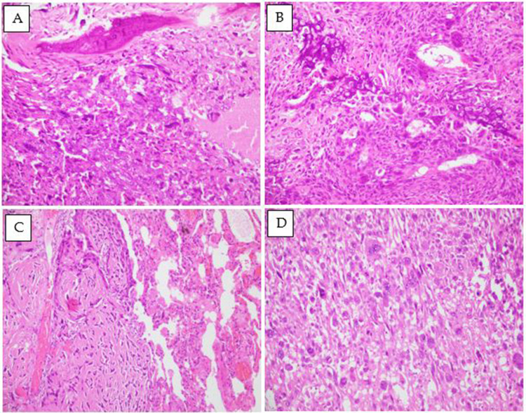 Evaluation of Indoleamine 2,3-Dioxygenase (IDO) Expression in Osteosarcoma: Insights From a 10-Year Retrospective Cohort.