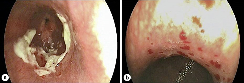Iron Mettle: Unveiling an Unusual Incidental Case Report of Esophageal Ulcer.