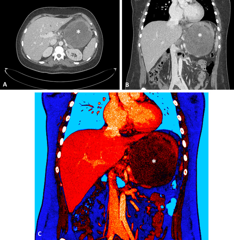Succinate dehydrogenase-deficient gastrointestinal stromal tumor of the stomach: EUS and contrast-enhanced EUS features (with videos).