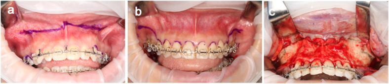 Factors affecting postoperative nasal morphology after Le Fort I osteotomy on multiple regression analysis.