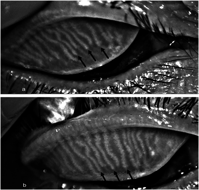 Treatment of Meibomian Gland Dysfunction by Classical Eyelid Hygiene Measures With and Without Additional Lipid Substitution for Tear Film Stabilization.