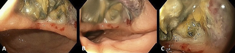 Succinate dehydrogenase-deficient gastrointestinal stromal tumor of the stomach: EUS and contrast-enhanced EUS features (with videos).