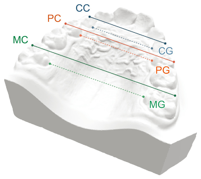 Predictability of maxillary dentoalveolar expansion with clear aligners in patients with mixed dentition.
