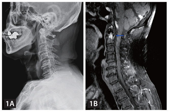 Acute gouty arthritis of the atlantoaxial joint.