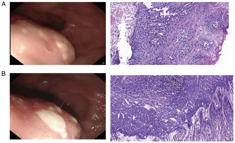 Misdiagnosis of esophageal leiomyoma combined with adrenal cortical adenoma as esophageal cancer with adrenal metastasis by fluorine-18-fluorodeoxyglucose positron emission tomography: A case report.