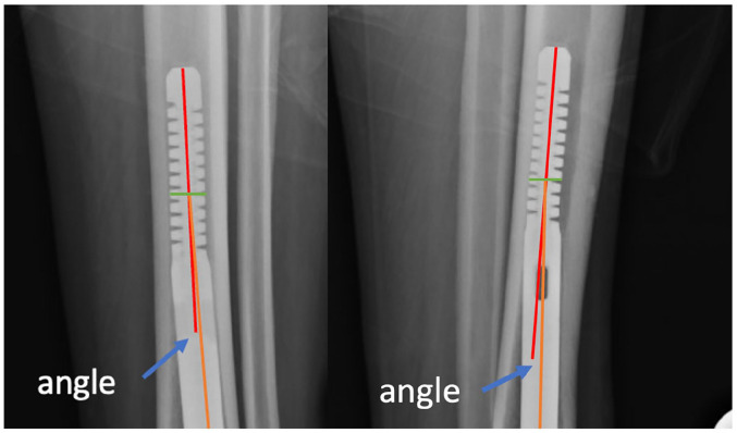 Complications and Early-Term Radiographic Analysis of a Novel Active Compression Tibiotalocalcaneal Arthrodesis Nail With a Proximal Flexible Coil.