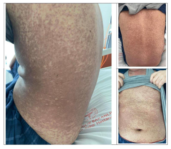 Successful Management of Steroid-Resistant cutaneous Acute Graft-versus-Host Disease, Toxic Epidermal Necrolysis-Like, with Ruxolitinib.