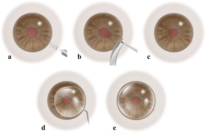 Iridectomy combined with posterior approach anterior chamber gas injection technique: a novel technique for the treatment of extensive Descemet's membrane detachment.