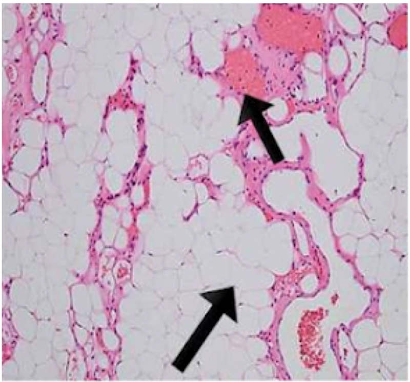 Spinal Extradural Angiolipoma: A Report of Two Cases and Review of Literature.