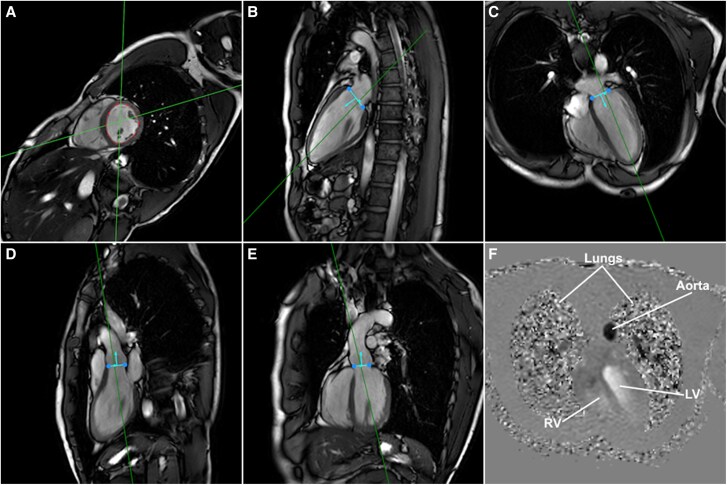 The effect of respiratory motion compensation in intracardiac 4D flow magnetic resonance imaging on left ventricular flow dynamics, multicomponent particle tracing, and valve tracking.