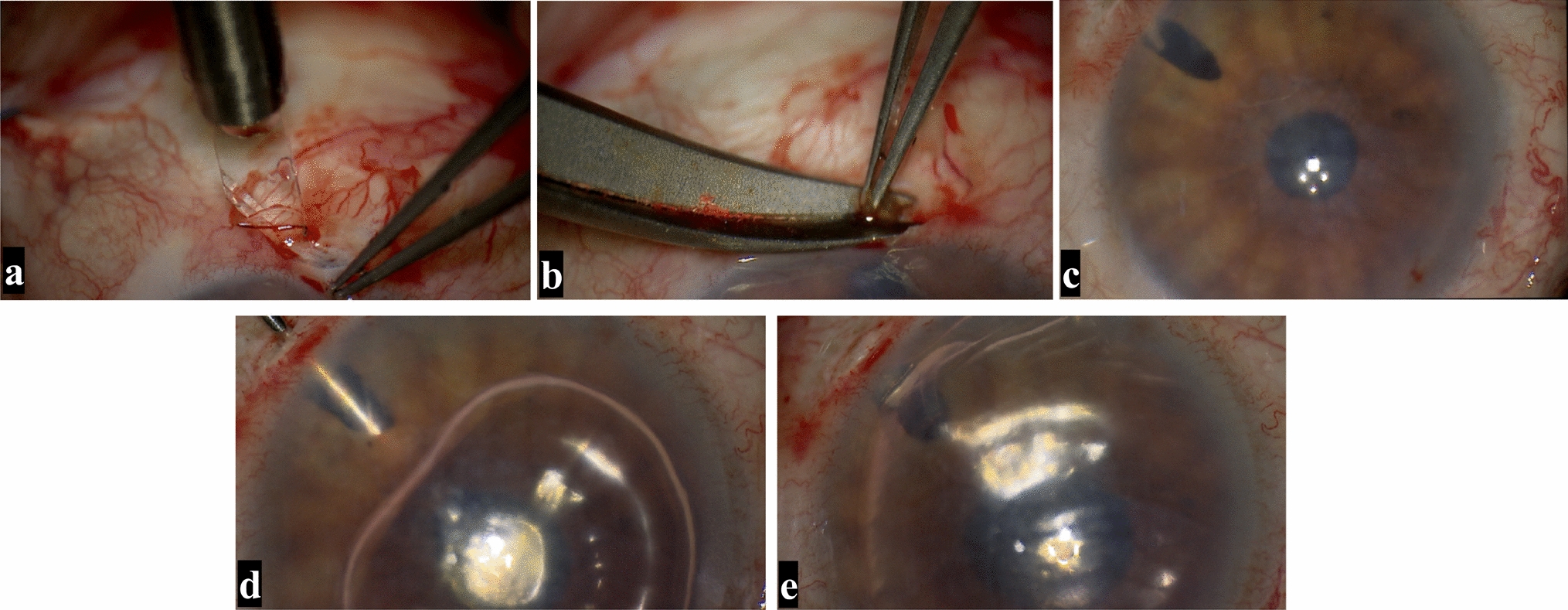 Iridectomy combined with posterior approach anterior chamber gas injection technique: a novel technique for the treatment of extensive Descemet's membrane detachment.