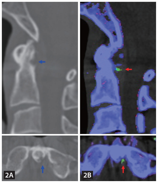 Acute gouty arthritis of the atlantoaxial joint.