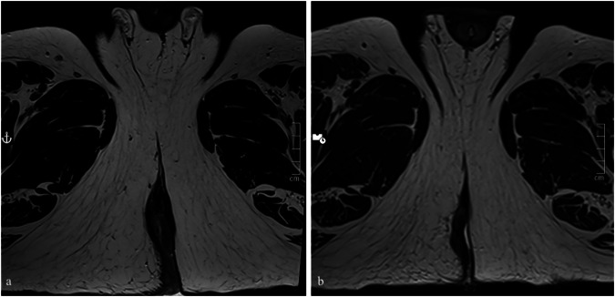 Radiomics to predict tumor response to combination chemoradiotherapy in squamous cell carcinoma of the anal canal: a preliminary investigation.