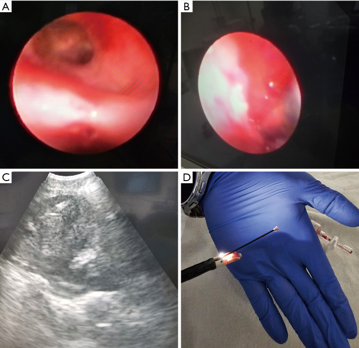 Mediastinal lymph node cryobiopsy guided by endobronchial ultrasound: a comprehensive review of methods and outcomes.