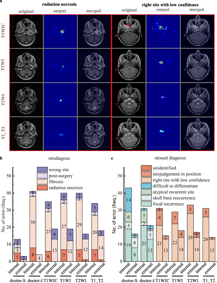 Establishment of a deep-learning-assisted recurrent nasopharyngeal carcinoma detecting simultaneous tactic (DARNDEST) with high cost-effectiveness based on magnetic resonance images: a multicenter study in an endemic area.