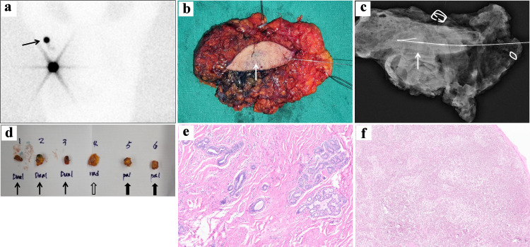 Successful Sentinel Lymph Node Biopsy in Accessory Breast Cancer.