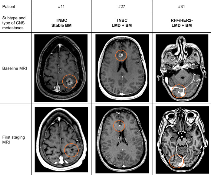 Real-World outcomes with sacituzumab govitecan among breast cancer patients with central nervous system metastases.