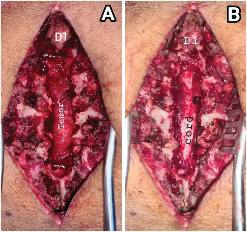 Spinal Extradural Angiolipoma: A Report of Two Cases and Review of Literature.