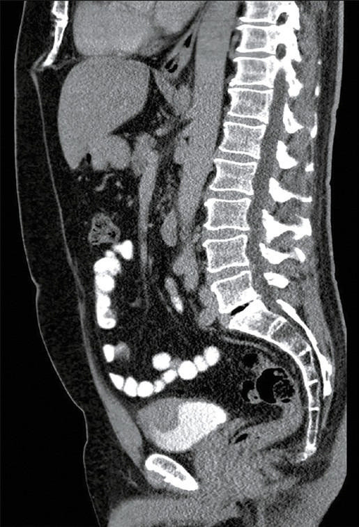 Robot‑assisted resection of a rare bladder tumor facilitated by perioperative bladder wall tattooing.