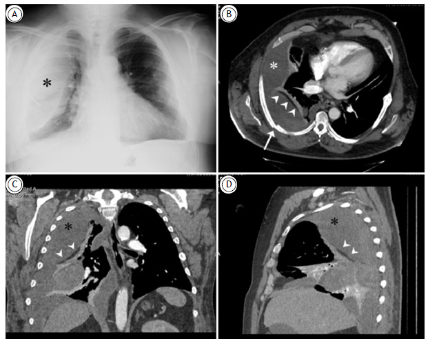 Right extrapleural hematoma due to thoracic trauma. The extrapleural fat sign.