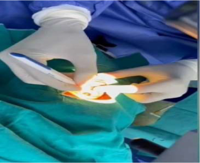 Use of a multifocal electroretinogram to evaluate the therapeutic effect of a single intravitreal dexamethasone implant, Ozurdex<sup>®</sup>, for refractory diabetic macular oedema.