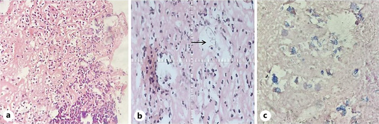Iron Mettle: Unveiling an Unusual Incidental Case Report of Esophageal Ulcer.