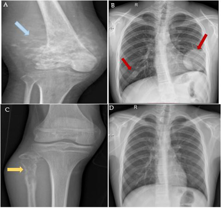 Evaluation of Indoleamine 2,3-Dioxygenase (IDO) Expression in Osteosarcoma: Insights From a 10-Year Retrospective Cohort.