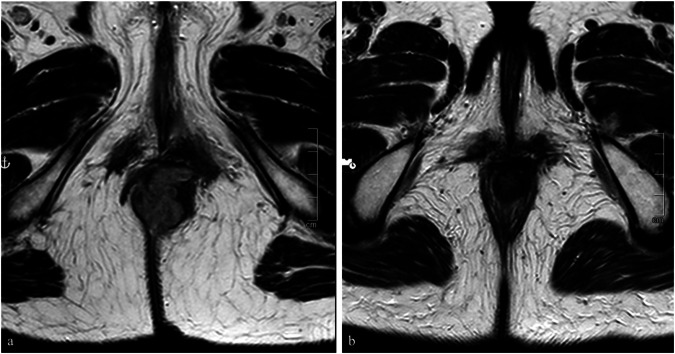 Radiomics to predict tumor response to combination chemoradiotherapy in squamous cell carcinoma of the anal canal: a preliminary investigation.