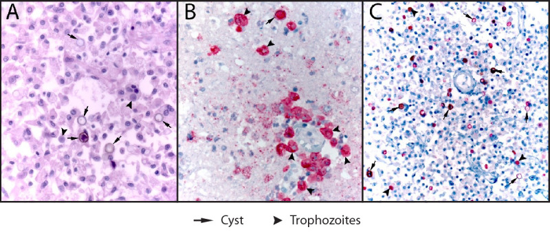 Notes from the Field: Fatal Acanthamoeba Encephalitis in a Patient Who Regularly Used Tap Water in an Electronic Nasal Irrigation Device and a Continuous Positive Airway Pressure Machine at Home - New Mexico, 2023.