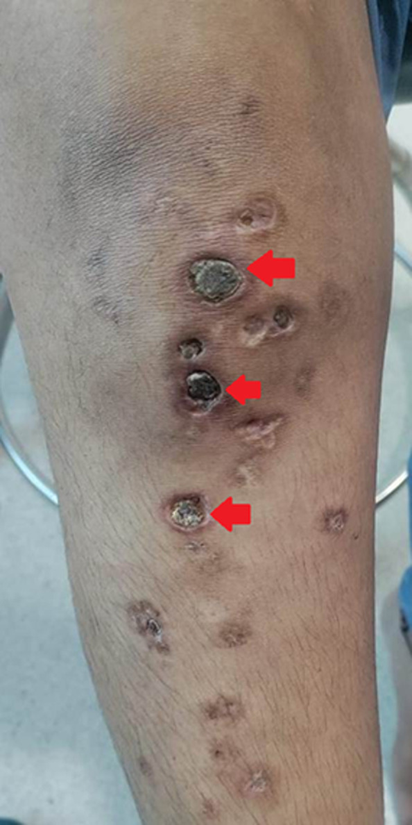 Livedoid vasculopathy in protein S deficiency.