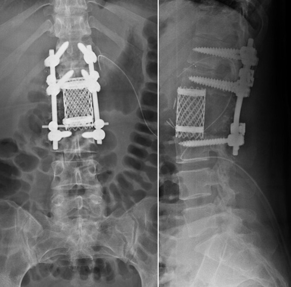 Long-term Titanium mesh cage implant failure after total en bloc spondylectomy due to spinal chondrosarcoma