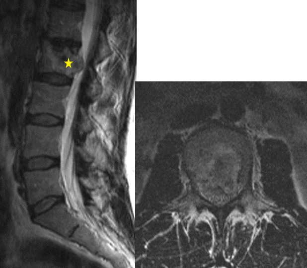 Long-term Titanium mesh cage implant failure after total en bloc spondylectomy due to spinal chondrosarcoma