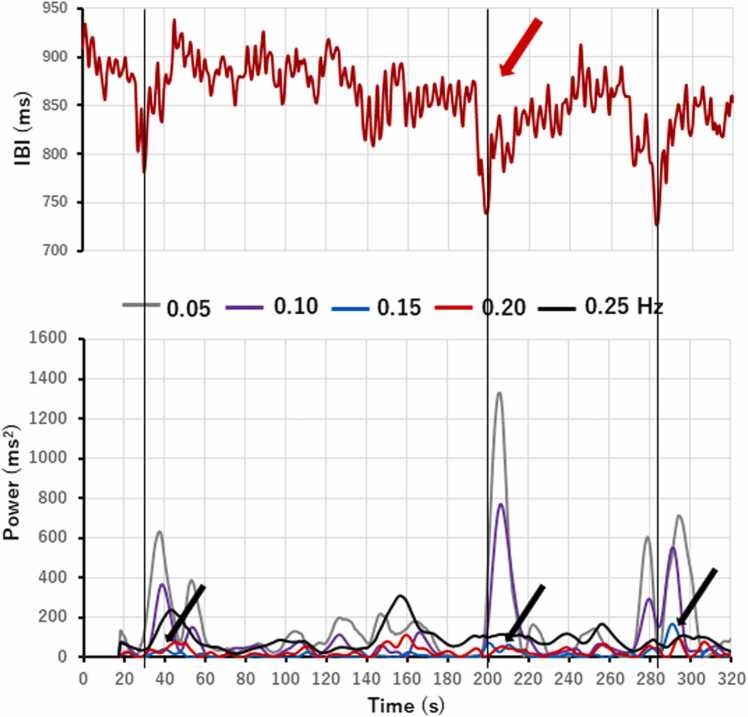 The difference in arterial baroreflex sensitivity between the supine and standing positions in healthy subjects.