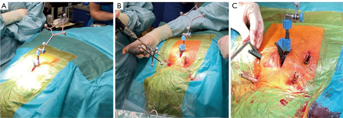 A new minimally invasive cervical pedicle screw (CPS) fixation system using intra-operative computed tomography-guided navigation.